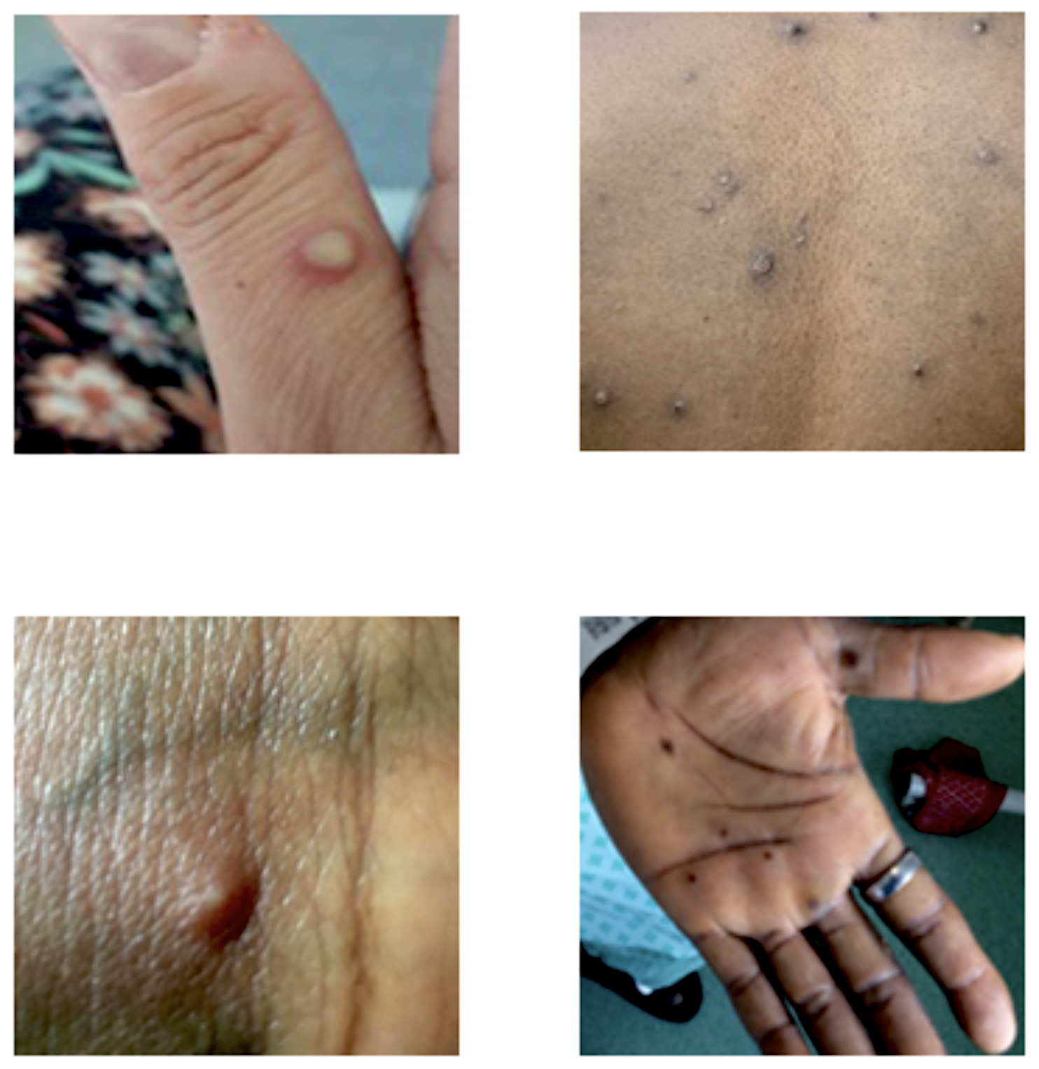 Images of monkeypox on skin surfaces