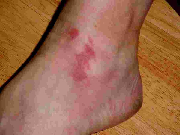 Burn from Giang Hogweed